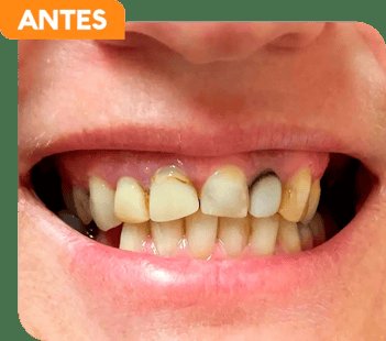 Dentes do paciente antes do tratamento odontológico