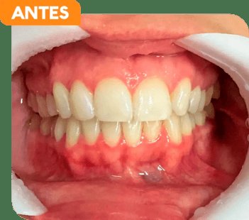 Dentes do paciente antes do tratamento ortodôntico