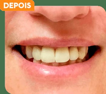 Sorriso do paciente depois do tratamento odontológico