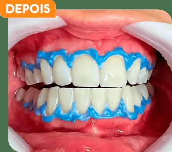 Tratamento ortodôntico em andamento no paciente